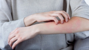 Острый приступ аллергии: что делать и когда нужно вызывать скорую? Объясняет врач